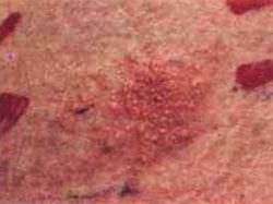 Результаты кожной аллергической пробы, оценка, фото