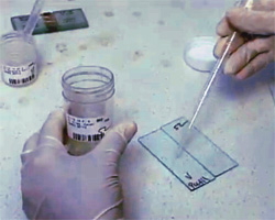 Диагноз мужского бесплодия по анализу спермы, фото