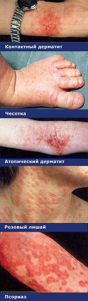 заболевания, сопровождающиеся зудом кожи, как выглядят, фото