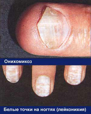 Заболевания ногтей, фото