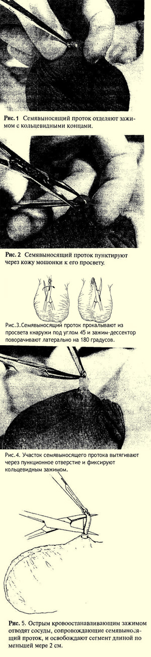 Как проходит операция мужской стерилизации, техника, иллюстрации