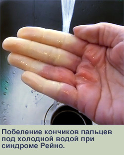 Спазм мелких артерий рук при синдроме Рейно, фото