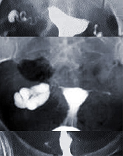 Диагностика проходимости маточных труб, фото
