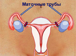 Методы хирургической стерилизации женщины, фото