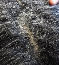Сухость и шелушение волосистой части головы, фото