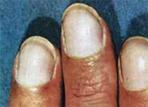 Белые ногти при циррозе печени, фото