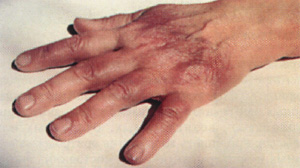 Красно-синяя кожа на руках после укуса клеща, фото