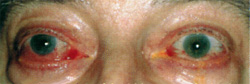 Эндокринная офтальмопатия, фото