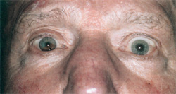 Неодинаковая ширина глазных щелей при триаде Хорнера, фото