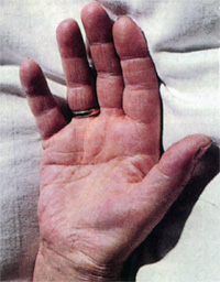 паралич локтевого нерва, фото