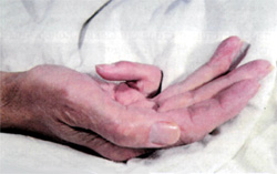 камптодактилия, контрактура пальцев кисти, фото