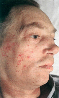Высыпания на коже, носовые кровотечения при болезни Рендю-Ослера-Вебера, фото