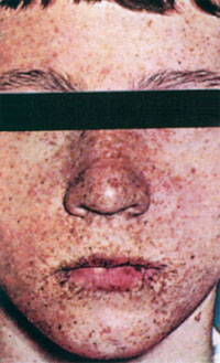 Веснушки на лице (лентиго) при синдроме Пейтца-Егерса-Клостермана-Турена, фото