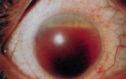 Кровоизлияние в глаз при геморрагическом диатезе, фото