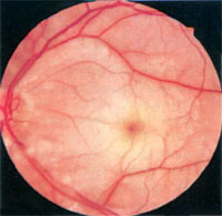 поражение глаз при ишемической нейропатии зрительного нерва, фото