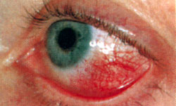 Диагностика узелкового периартериита по сосудам глаза, фото