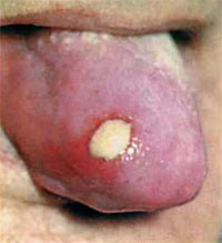Проявления третичного сифилиса, фото