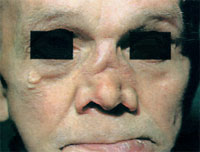 Пример третичного сифилиса, фото