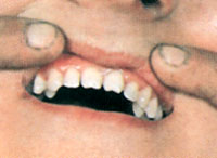 Зубы при сифилисе, фото