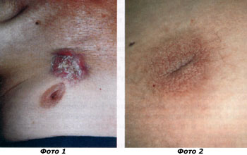 метастазы опухоли на коже, фото
