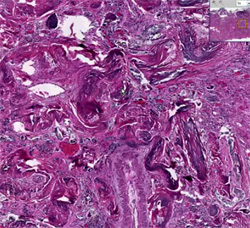 Серповидно-клеточная анемия, фото
