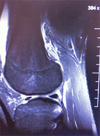  МРТ коленного сустава, фото