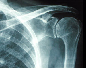 Рентген плечевого сустава, фото