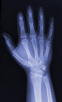 Рентген кисти, фото