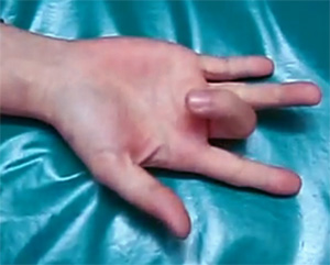 Крючкообразный палец, фото