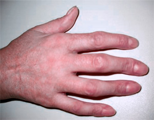 Деформация пальцев кисти в виде лебединой шеи, фото