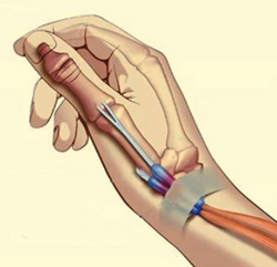 Тендовагинит мышцы, отводящей большой палец, фото