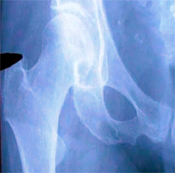Рентген тазобедренных суставов, фото