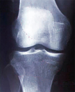 Рентген коленного сустава, фото