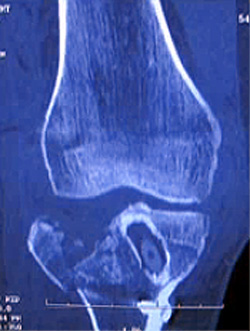 Перелом коленного сустава, фото