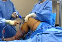 Разрыв мениска коленного сустава, фото
