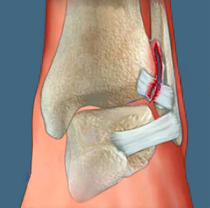 Разрыв связок голеностопного сустава, фото