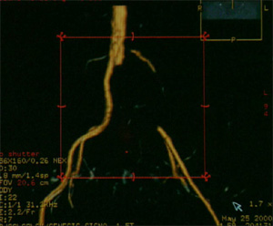 Тромб бедренной артерии на МРТ, фото