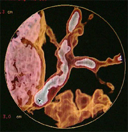 Атеросклеротические бляшки в сосудах сердца, фото