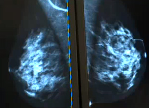 Метапластический рак молочной железы, фото