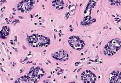 гликогенсодержащий светлоклеточный рак молочной железы, фото