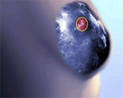 Воспалительный рак молочной железы, запущенная форма рака, фото
