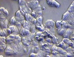 Веретеноклеточный и светлоклеточный протоковый рак in situ, фото