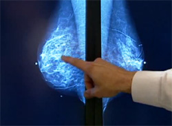 Микроинвазивный рак молочной железы, фото