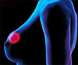 Факторы риска рака молочной железы, фото