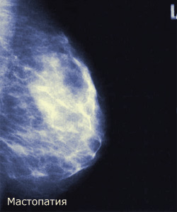 Методы отбора в группу риска рака молочной железы, фото