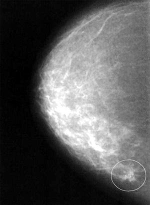 рак молочной железы, фото