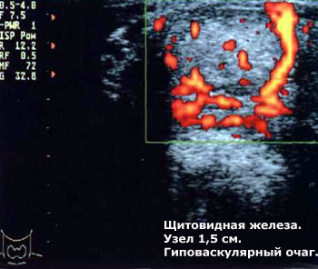 Узел в левой доле щитовидной железы