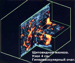 трехмерная ультразвуковая томография, фото